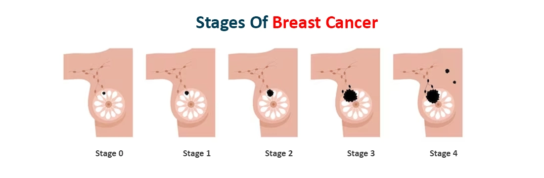 Stages of Breast Cancer